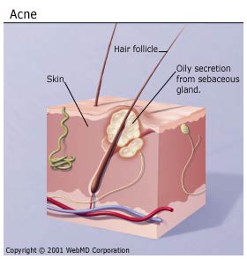 acne image