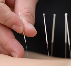 acupuncture image